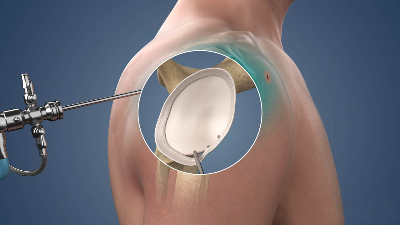 ACL Reconstruction surgery